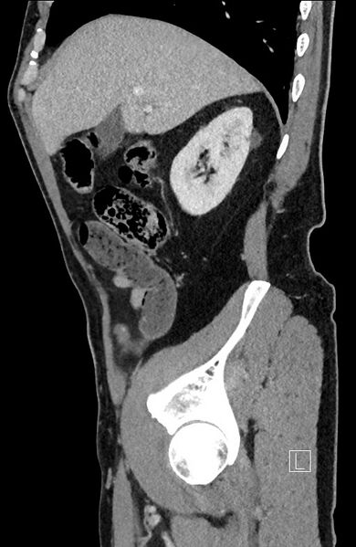 File:Closed loop small bowel obstruction - internal hernia (Radiopaedia 57806-64778 C 84).jpg