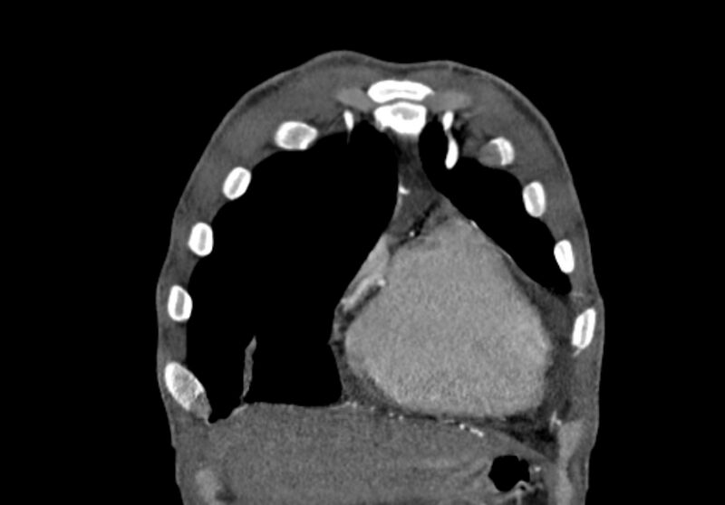 File:Coarctation of aorta with aortic valve stenosis (Radiopaedia 70463-80574 C 17).jpg