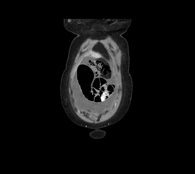File:Cocoon abdomen with possible tubo-ovarian abscess (Radiopaedia 46235-50636 B 5).jpg
