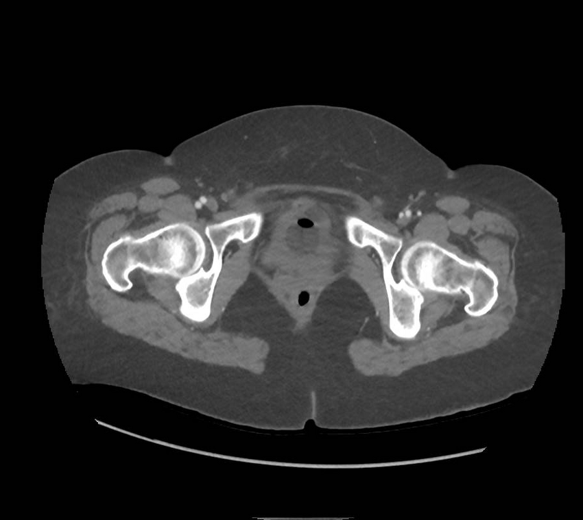 Colonic pseudo-obstruction (Radiopaedia 79752-92980 A 186).png