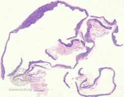 Branchial cleft cyst/pathology