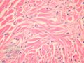Figure 2 (DermNet NZ pathology-e-angiofibroma-figure-2).jpg