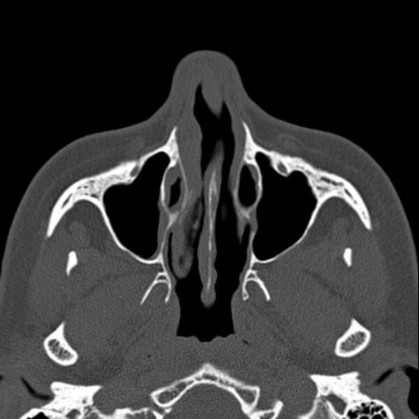 File:Nasal septal perforation (Radiopaedia 25030-25289 Axial bone window 17).jpg
