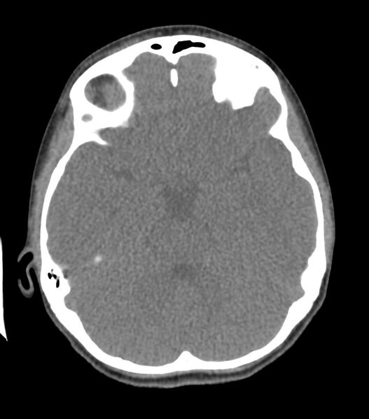 File:Nasoorbitoethmoid fracture (Radiopaedia 90044-107205 Axial non-contrast 183).jpg