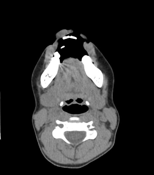 File:Nasoorbitoethmoid fracture (Radiopaedia 90044-107205 Axial non-contrast 58).jpg