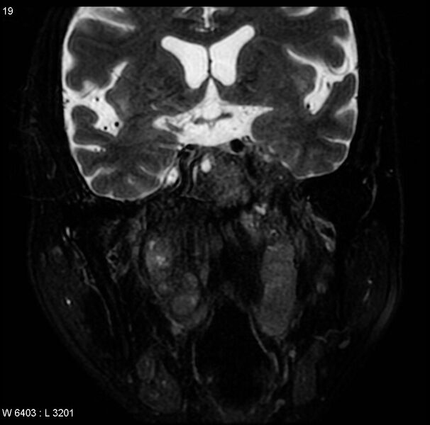 File:Nasopharyngeal carcinoma (Radiopaedia 4546-6667 Coronal T2 7).jpg