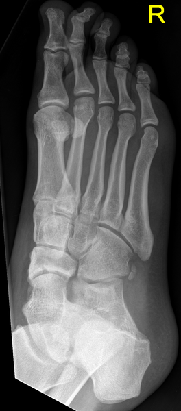 File:Navicular fracture (Radiopaedia 31710-32632 Oblique 1).png