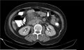 Necrotizing pancreatitis (Radiopaedia 20595-20495 Axial C+ delayed 19).jpg