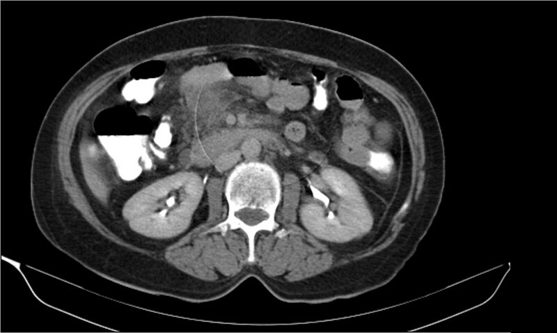 File:Necrotizing pancreatitis (Radiopaedia 20595-20495 Axial C+ delayed 19).jpg