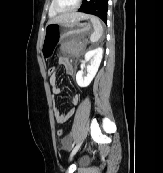 File:Necrotizing pancreatitis (Radiopaedia 23001-23031 C 56).jpg