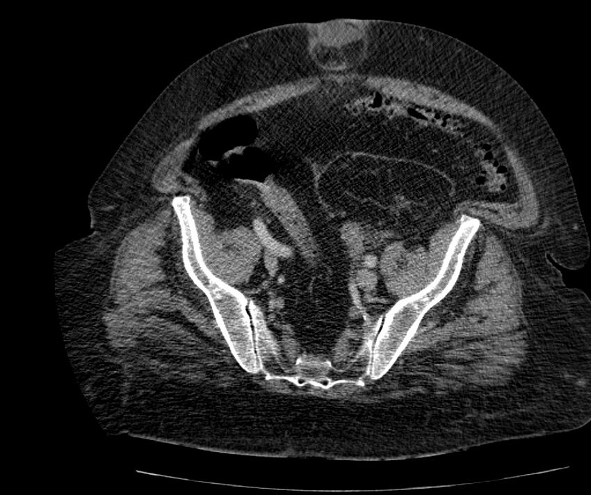 Nephroptosis with inguinal hernia containing perirenal fat (Radiopaedia 56632-63391 C 274).jpg