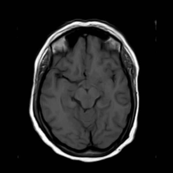 File:Neurofibromatosis type 2 (Radiopaedia 67470-76871 Axial T1 10).jpg