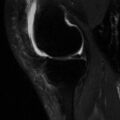 Non-displaced patella fracture (Radiopaedia 15932-15582 Sagittal T2 fat sat 6).jpg
