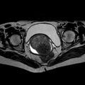 Non-puerperal uterine inversion (Radiopaedia 78343-90983 Axial T2 15).jpg