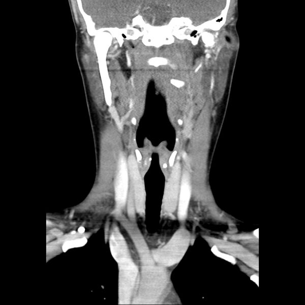 File:Normal CT of the neck (Radiopaedia 14575-14500 Coronal C+ 27).jpg
