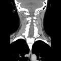 Normal CT of the neck (Radiopaedia 14575-14500 Coronal C+ 37).jpg