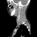 Normal CT of the neck (Radiopaedia 14575-14500 Sagittal C+ 16).jpg