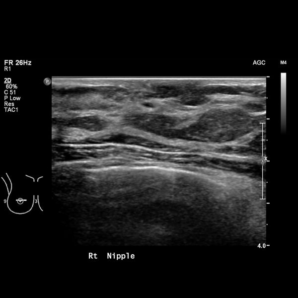 File:Normal breast mammography (tomosynthesis) and ultrasound (Radiopaedia 65325-74354 Right breast 13).jpeg
