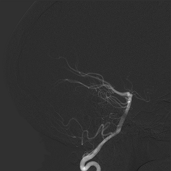 File:Normal cerebral angiogram (four vessel DSA) (Radiopaedia 41708-44649 L 7).png