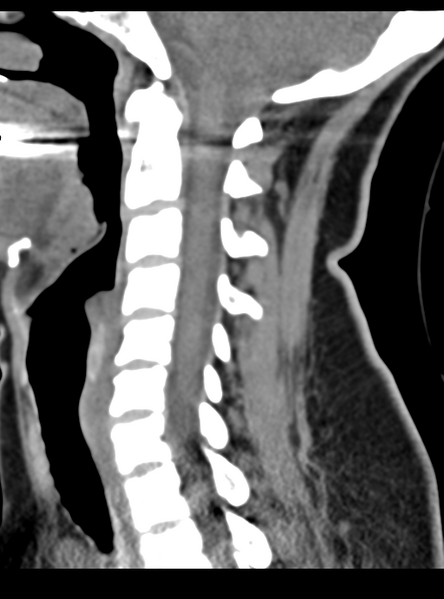 File:Normal cervical spine MRI (including Dixon) (Radiopaedia 42762-45926 C 29).png