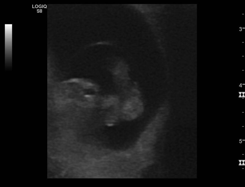 Normal early pregnancy - 8w0d (Radiopaedia 44715-48492 Longitudinal 49).jpg