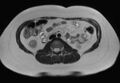 Normal liver MRI with Gadolinium (Radiopaedia 58913-66163 Axial T2 6).jpg