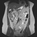 Normal liver MRI with Gadolinium (Radiopaedia 58913-66163 Coronal T2 17).jpg