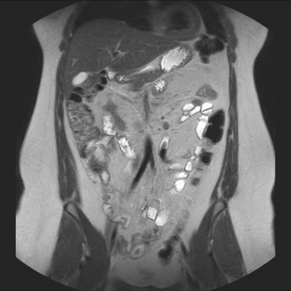 File:Normal liver MRI with Gadolinium (Radiopaedia 58913-66163 Coronal T2 17).jpg
