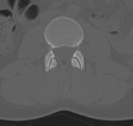 Normal lumbar spine CT (Radiopaedia 46533-50986 Axial bone window 32).png