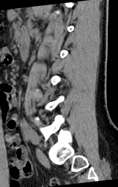 File:Normal lumbar spine CT (Radiopaedia 46533-50986 C 36).png