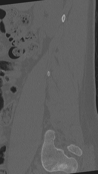 File:Normal lumbar spine CT (Radiopaedia 46533-50986 Sagittal bone window 82).png