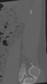 Normal lumbar spine CT (Radiopaedia 46533-50986 Sagittal bone window 87).png