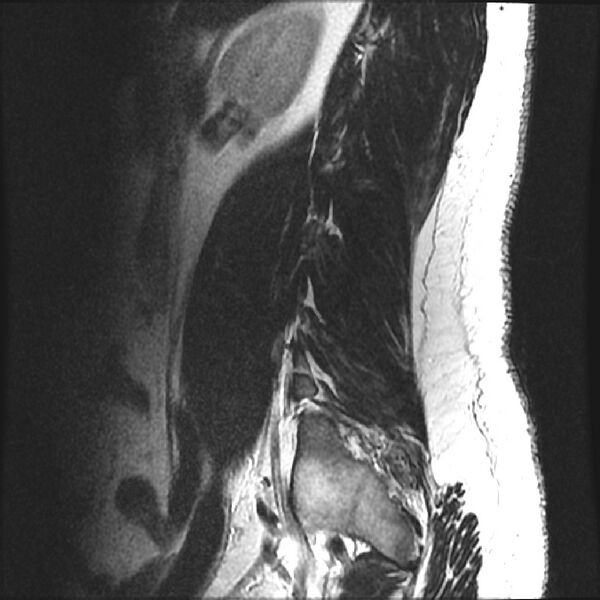File:Normal lumbar spine MRI (Radiopaedia 43051-46311 Sagittal T2 20).jpg