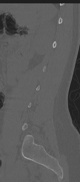 File:Normal lumbosacral CT (Radiopaedia 37923-39867 Sagittal bone window 26).png