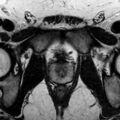 Normal prostate (MRI) (Radiopaedia 29986-30535 Axial T2 6).jpg