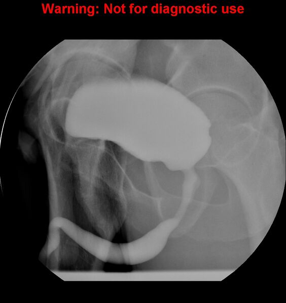 File:Normal retrograde urethrogram (RUG) and voiding cystourethrogram (VCUG) (Radiopaedia 40478-43050 VCUG 8).jpg