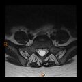 Normal spine MRI (Radiopaedia 77323-89408 Axial T2 25).jpg