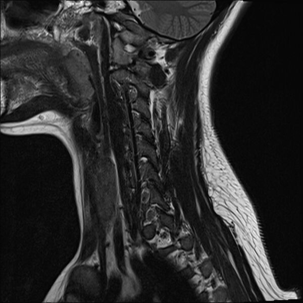 File:Normal trauma cervical spine MRI (Radiopaedia 32130-33071 Sagittal T2 2).jpg