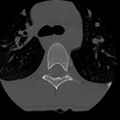 Normal trauma spine imaging (age 16) (Radiopaedia 45335-49358 Axial bone window 112).jpg