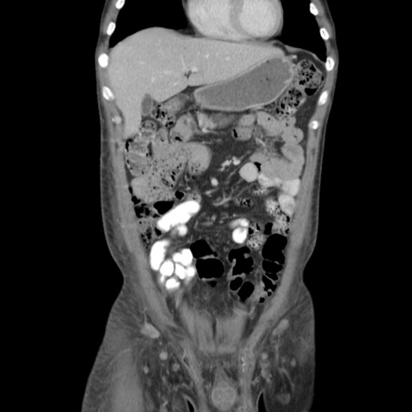 File:Obstructive bladder transitional cell carcinoma (Radiopaedia 9825-10410 B 1).jpg