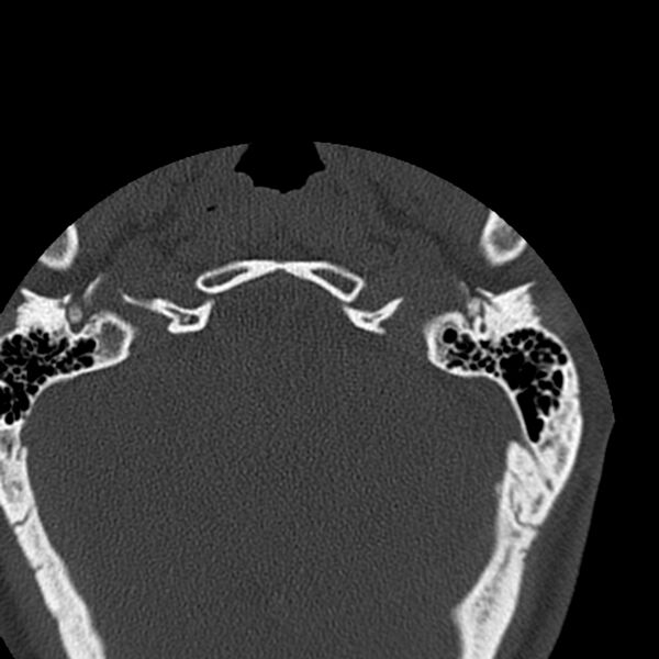 File:Occipital condyle fracture (Radiopaedia 31755-32691 Axial bone window 2).jpg
