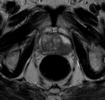 MRI Organ-confined prostate cancer
