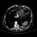 Abdominal aortic aneurysm (Radiopaedia 25855-26001 Axial C+ arterial phase 18).jpg