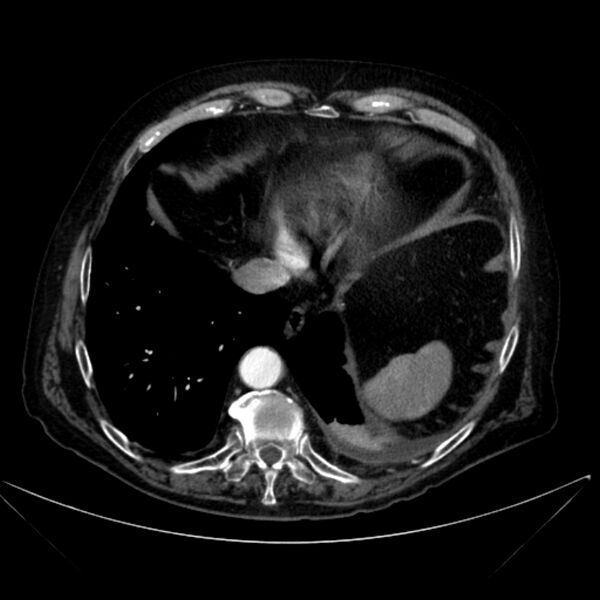 File:Abdominal aortic aneurysm (Radiopaedia 25855-26001 Axial C+ arterial phase 18).jpg