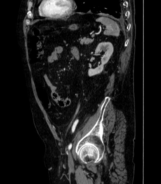 File:Abdominal aortic aneurysm (Radiopaedia 25855-26001 Sagittal C+ arterial phase 57).jpg