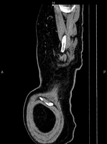 File:Abdominal aortic aneurysm (Radiopaedia 83094-97462 Sagittal renal cortical phase 7).jpg