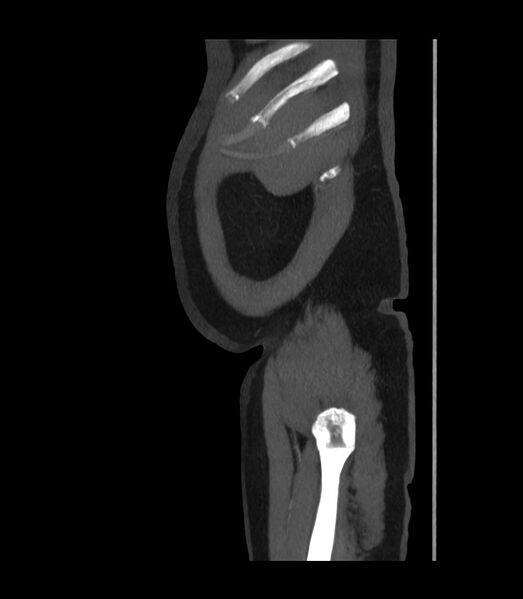 File:Abdominal aortic aneurysm with thrombus fissuration (Radiopaedia 46218-50618 Sagittal C+ arterial phase 3).jpg