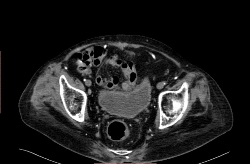 File:Abdominal aortic interposition tube graft and aneurysm thrombosis (Radiopaedia 71438-81857 Axial C+ arterial phase 208).jpg