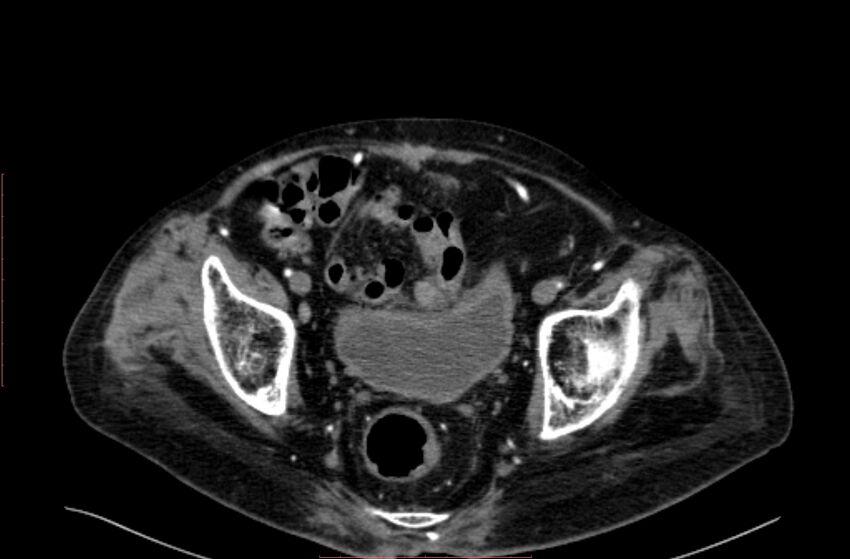 Abdominal aortic interposition tube graft and aneurysm thrombosis (Radiopaedia 71438-81857 Axial C+ arterial phase 208).jpg