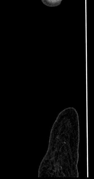 File:Abdominal wall and retroperitoneal tuberculosis (Radiopaedia 88137-104729 Sagittal C+ portal venous phase 150).jpg